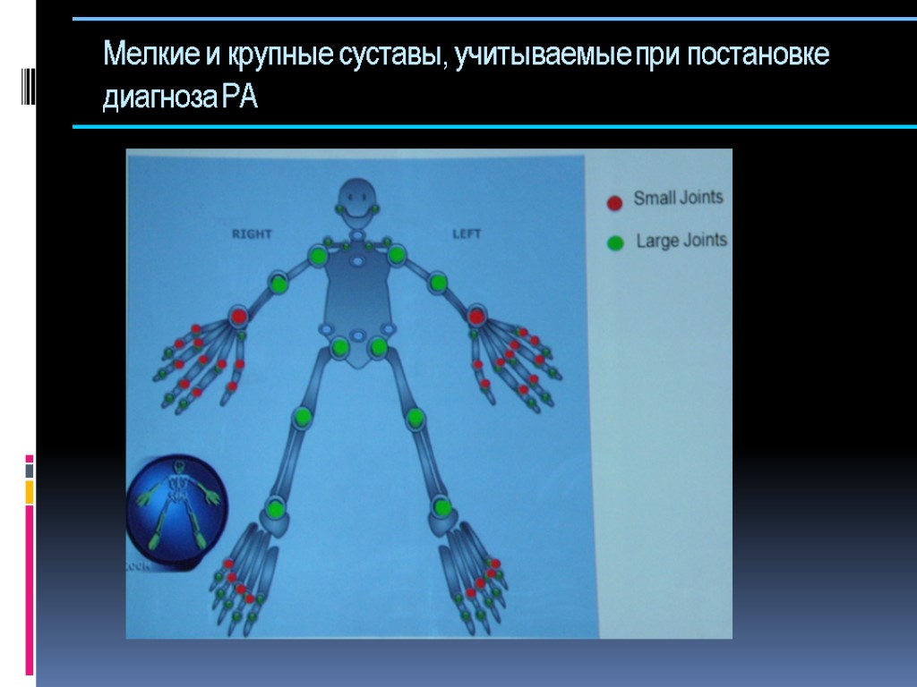 Мелкие и крупные суставы, учитываемые при постановке диагноза РА